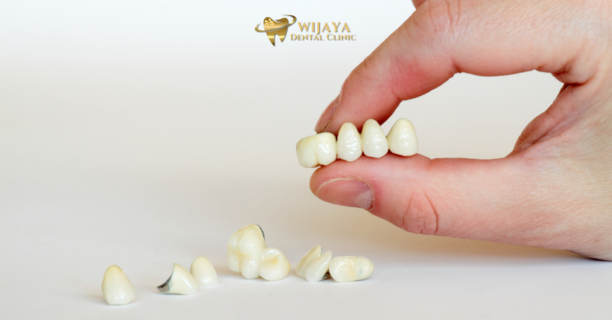 Crown Gigi: Definisi, Fungsi, Jenis Serta Prosedur.